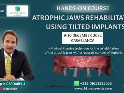 Minimal invasive technique for the rehabilitation of the atrophic jaws with a reduced number of implants
