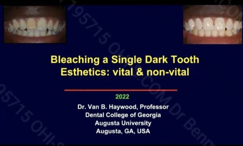 Bleaching a Single Discolored Tooth: Vital and non-Vital Techniques